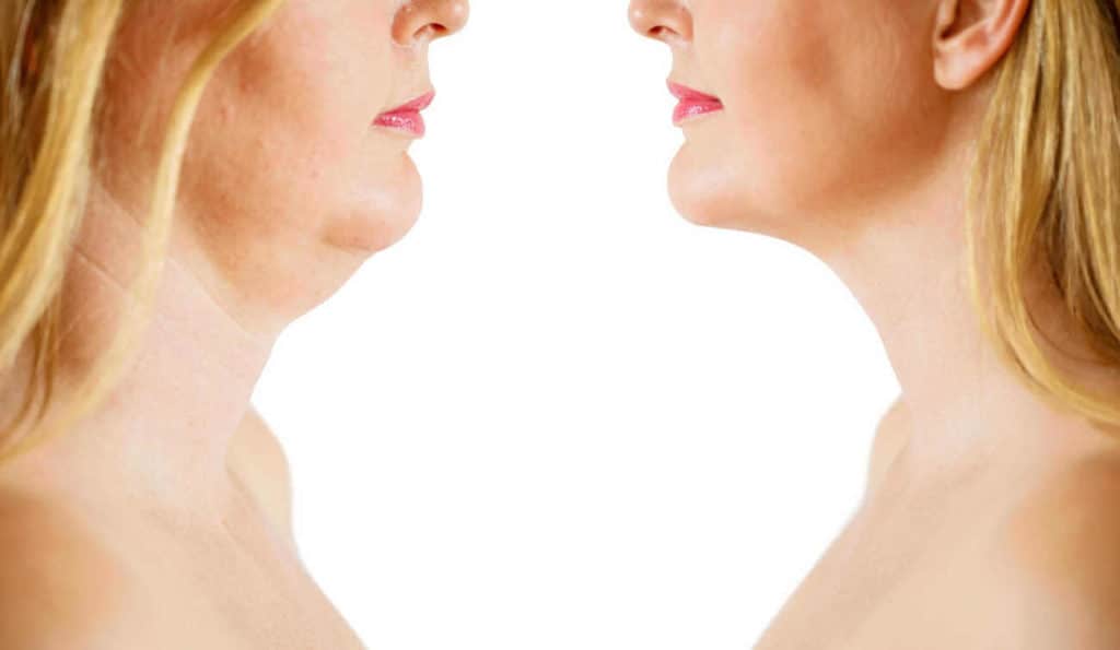 Double Chin treatment Perivale before and after results