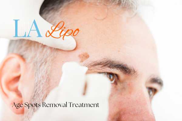 What Are the Most Effective Treatments for Age Spots Perivale?