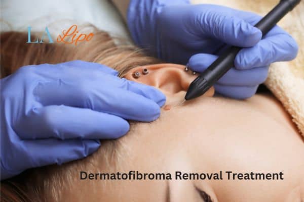 Dermatofibroma Removal Treatment Perivale