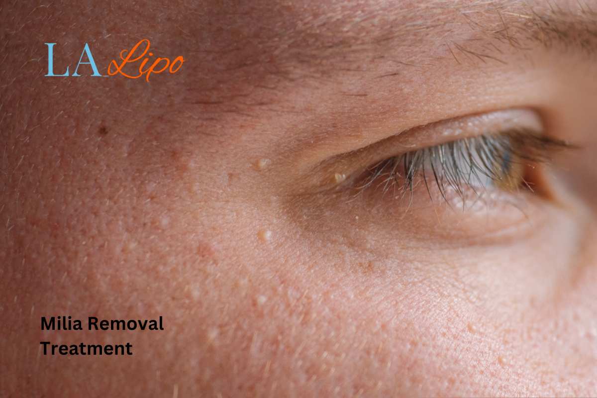 Cryopen Milia Removal: Is It the Easiest and Safest Option Perivale?