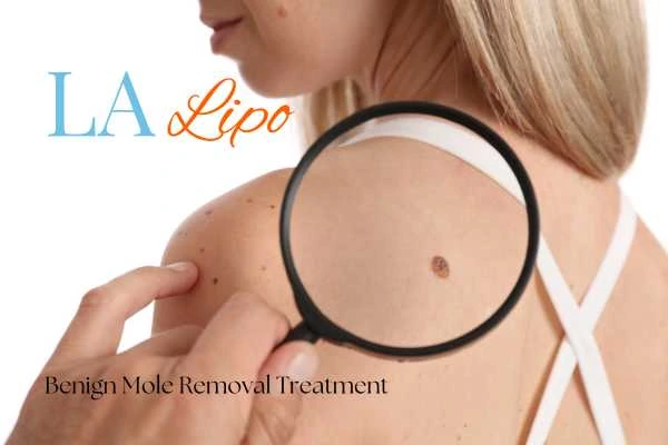 Woman having her inspection of blemish before mole removal Perivale