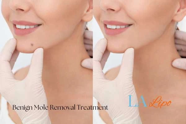 woman's before and after mole removal Perivale results