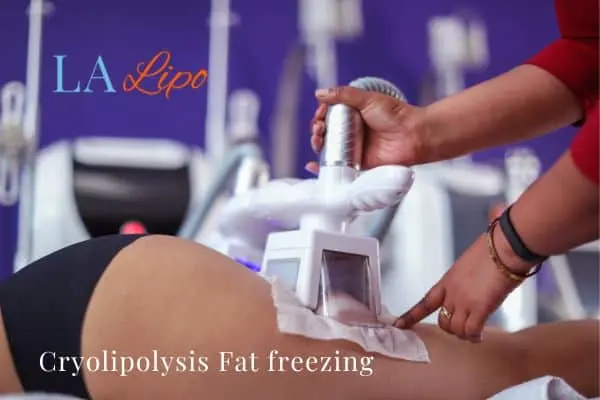 women getting fat freezing Perivale