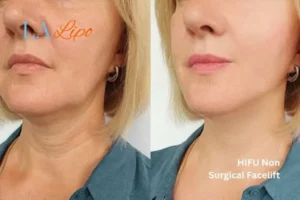 hi-fu for wrinkles Perivale before and after results