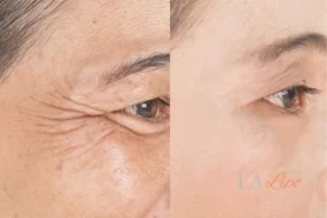 Before and after results of woman - HI-fu wrinkles reduction treatment Perivale