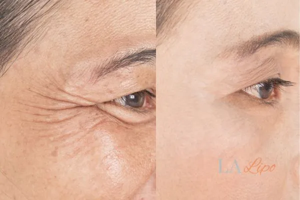 Before and after results of woman - HI-fu wrinkles reduction treatment Perivale