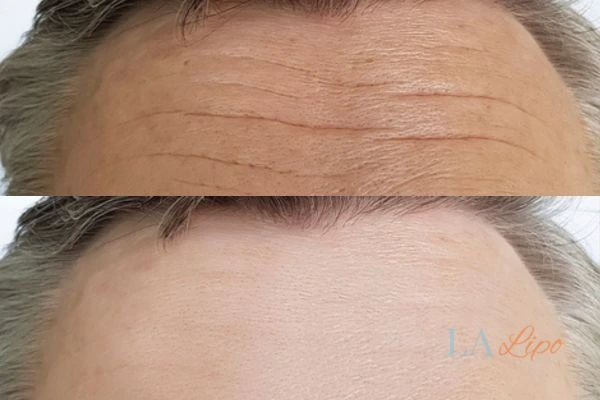 results of HIFU Perivale on mans forehead to help reduce lines and wrinkles