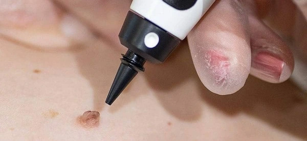 skin tag removal using cryopen Perivale