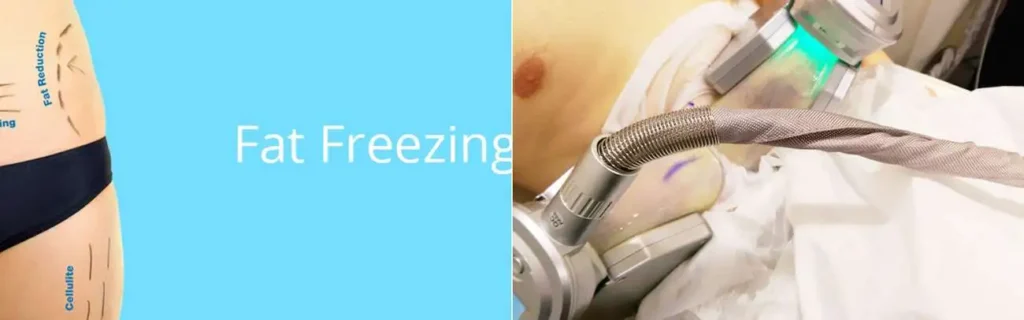 multi areas of a persons body having coolsculpting Perivale treatment