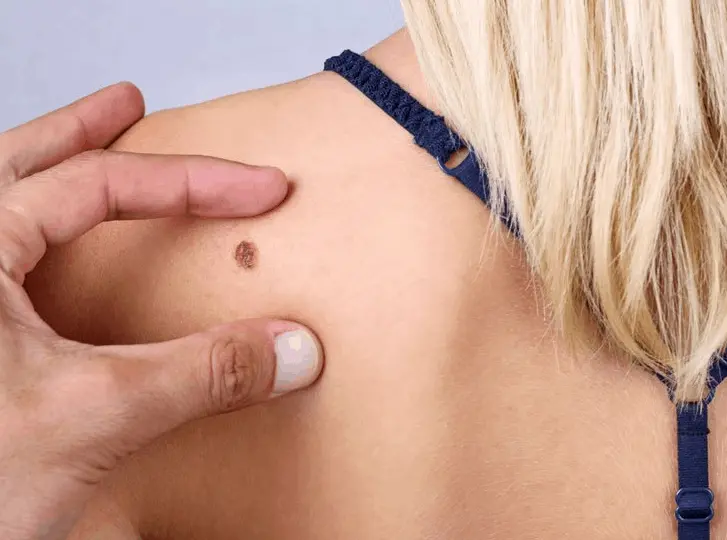 woman having mole removal Perivale consultation before treatment.
