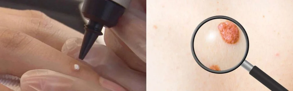 Person getting moles removed with cryopen Perivale