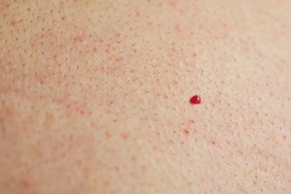 close up of a cherry angioma Perivale
