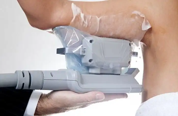 Picture of fat freezing Perivale on the upper arms.