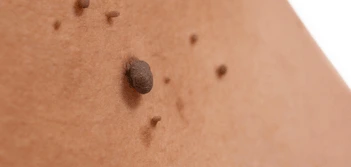 image of a skin tag Perivale