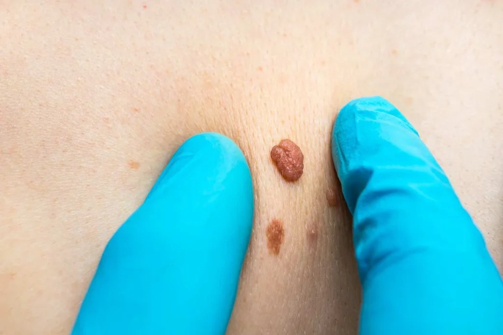 Consultant examining a skin tag Perivale
