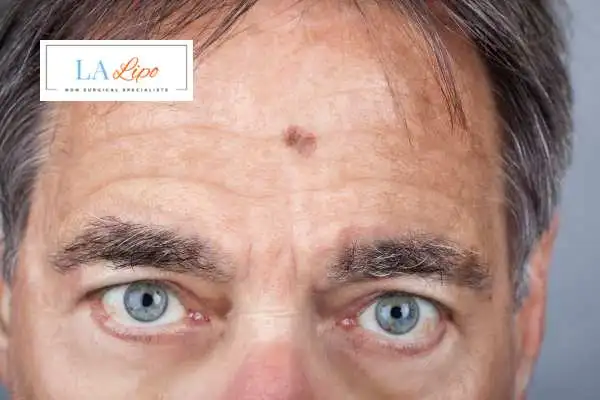 Solar Lentigo Removal Perivale image of man with mark on his forehead