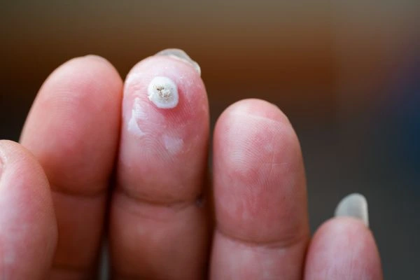 wart on person finger - cryotherapy to treat from LA LIPO Perivale