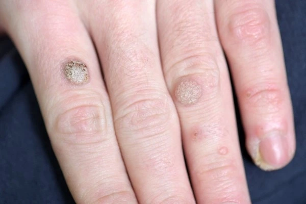 photo of warts on person hand - see wart removal Perivale from LA LIPO