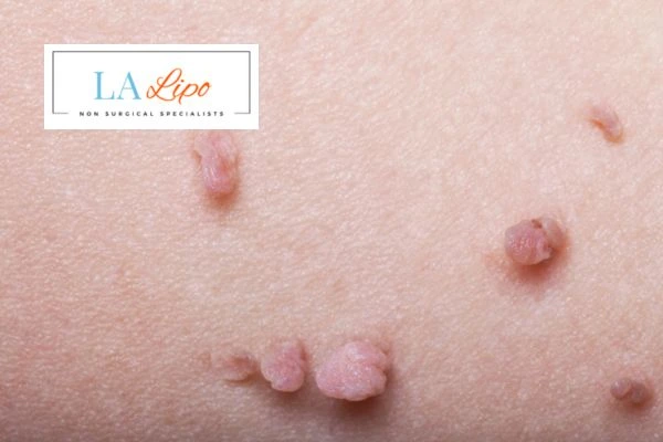 Does cryopen skin tag removal Perivale hurt? Find out now call our team today!