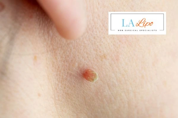 Book skin tag removal Perivale today speak to our team now!
