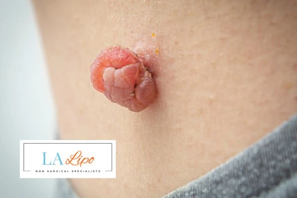 Interested in skin tag removal Perivale? Concerned about the pain? Find out more today!