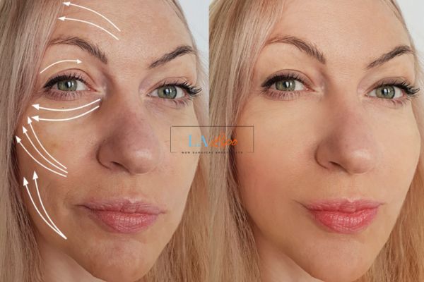 Morpheus 8 results Perivale face lift.