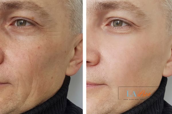 See the amazing results of Morpheus8 Treatment Perivale!