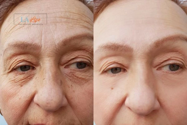 The powerful benefits of Morpheus8 Treatment Perivale - Call Our team today!