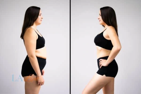 Picture of womans before and after using LA-EMS body sculpting to improve her core strength Perivale