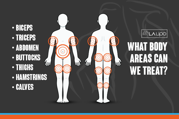 Diagram to show areas you can have LA-EMS Body Sculpting Treatment Perivale