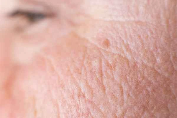 close up picture of a woman's face showing an age spot Perivale