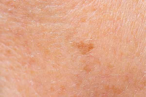 close up picture of age spots Perivale