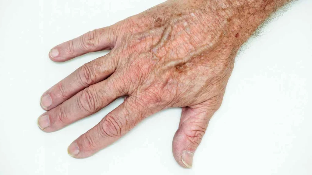 Male hand showing age spot Perivale