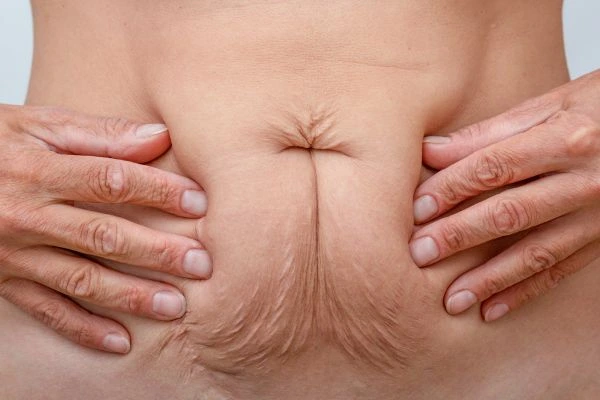 Image of a woman's stomach with loose skin - example of skin tightening Perivale options
