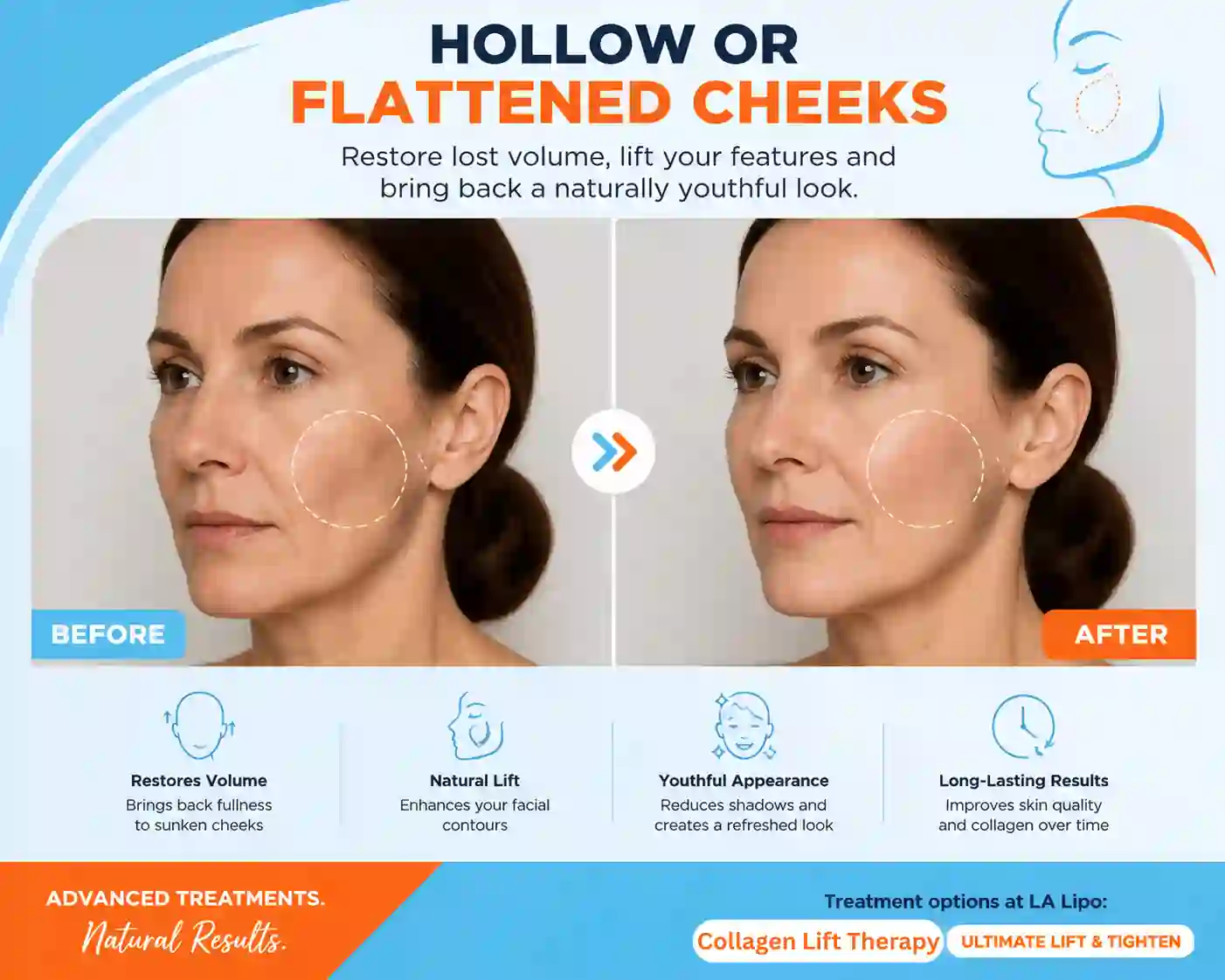 Sign #4: Hollow or Flattened Cheeks Perivale
