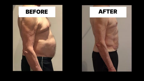 What Symptoms Can Diastasis Recti Cause in Men? Weak Core, Back Pain and Poor Posture Perivale